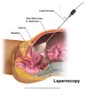 Endometriosis Treatment in Mumbai