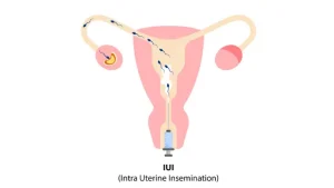 IUI Treatment in Mumbai