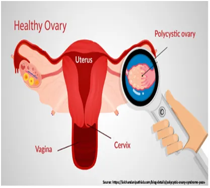 Gynecological Treatment in Mumbai