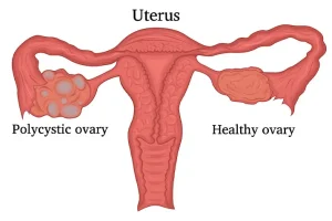 PCOS Treatment in Mumbai