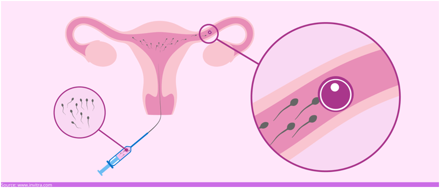 IUI treatment 