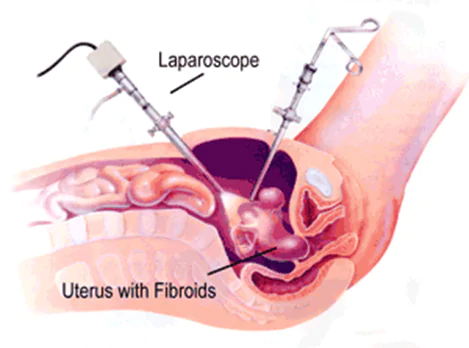 Fibroids Removal 