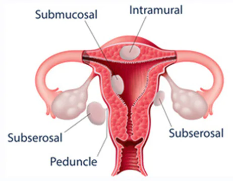Positions where fibroids can be present