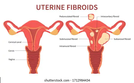 Uterine Fibroids