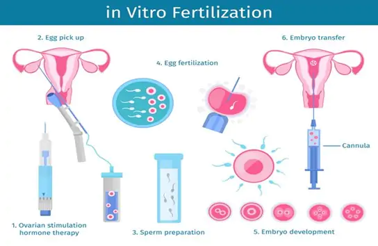 Does-IVF-Work-for-Turner-Syndrome
