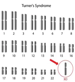 Introduction-of-Turner-Syndrome