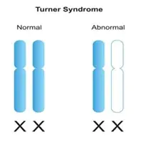 Prevalence-of-Turner-Syndrome-and-its-Impact-on-Reproductive-Health
