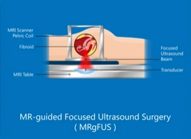 MRI-guided Focused Ultrasound