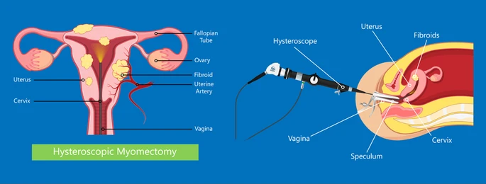 Myomectomy