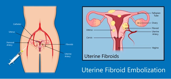 Uterine Fibroid Embolization