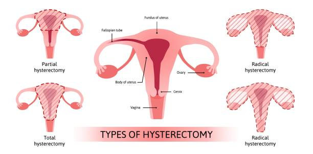 Hysterectomy