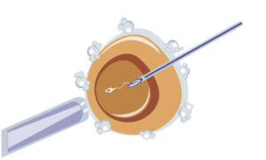 Assisted Laser Hatching