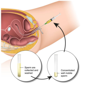 Embryo transfer